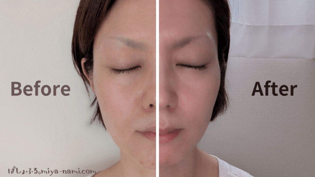 カレントボディマルチライトマスク
赤色LED
顔正面ほうれい線のビフォーアフター