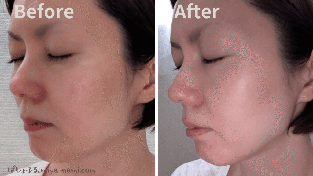 カレントボディマルチライトマスク
赤色LED
横顔ほうれい線のビフォーアフター